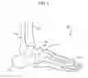 Fig. 02 - Sock with support assemblage