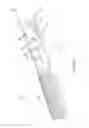 Fig. 04 - BALLOON ATHERECTOMY CATHETERS WITH IMAGING