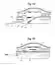 Fig. 07 - Graft prosthesis with pocket for microsystem