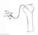 Fig. 01 - Arthroscopic total shoulder arthroplasty