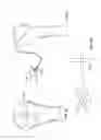 Fig. 04 - Arthroscopic total shoulder arthroplasty