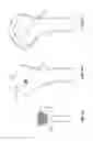 Fig. 06 - Arthroscopic total shoulder arthroplasty