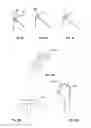 Fig. 08 - Arthroscopic total shoulder arthroplasty