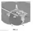 Fig. 03 - Utilization of laser interstitial thermotherapy guided with real time thermal MRI