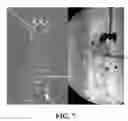 Fig. 07 - Utilization of laser interstitial thermotherapy guided with real time thermal MRI