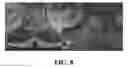 Fig. 08 - Utilization of laser interstitial thermotherapy guided with real time thermal MRI