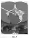 Fig. 09 - Utilization of laser interstitial thermotherapy guided with real time thermal MRI