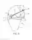 Fig. 06 - System and technique for accessing extra articular lesions or abnormalities or intra osseous lesions or bone marrow lesions