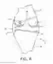 Fig. 07 - System and technique for accessing extra articular lesions or abnormalities or intra osseous lesions or bone marrow lesions