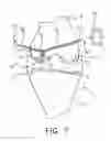 Fig. 08 - System and technique for accessing extra articular lesions or abnormalities or intra osseous lesions or bone marrow lesions