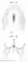 Fig. 09 - Palatal expansion appliance