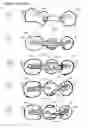 Fig. 06 - Direct dental bridge