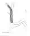 Fig. 216 - Aspiration devices and methods