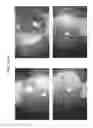Fig. 101 - Prosthetic capsular devices, systems, and methods