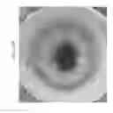 Fig. 65 - Prosthetic capsular devices, systems, and methods