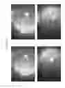 Fig. 66 - Prosthetic capsular devices, systems, and methods