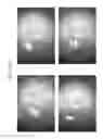 Fig. 67 - Prosthetic capsular devices, systems, and methods