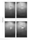 Fig. 68 - Prosthetic capsular devices, systems, and methods