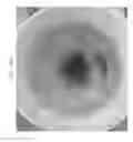 Fig. 70 - Prosthetic capsular devices, systems, and methods