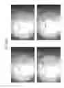 Fig. 72 - Prosthetic capsular devices, systems, and methods