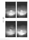 Fig. 74 - Prosthetic capsular devices, systems, and methods