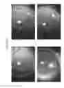 Fig. 76 - Prosthetic capsular devices, systems, and methods