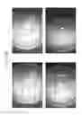 Fig. 77 - Prosthetic capsular devices, systems, and methods
