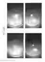 Fig. 79 - Prosthetic capsular devices, systems, and methods
