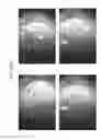 Fig. 82 - Prosthetic capsular devices, systems, and methods