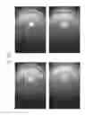 Fig. 83 - Prosthetic capsular devices, systems, and methods