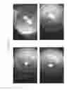Fig. 86 - Prosthetic capsular devices, systems, and methods