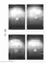 Fig. 87 - Prosthetic capsular devices, systems, and methods