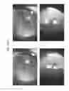 Fig. 91 - Prosthetic capsular devices, systems, and methods