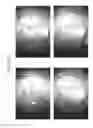 Fig. 92 - Prosthetic capsular devices, systems, and methods