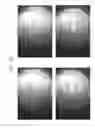 Fig. 93 - Prosthetic capsular devices, systems, and methods