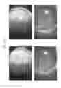 Fig. 94 - Prosthetic capsular devices, systems, and methods