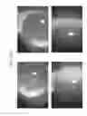 Fig. 96 - Prosthetic capsular devices, systems, and methods