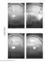 Fig. 97 - Prosthetic capsular devices, systems, and methods