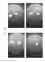 Fig. 98 - Prosthetic capsular devices, systems, and methods