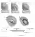 Fig. 03 - Platforms for mitral valve replacement