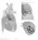 Fig. 05 - Platforms for mitral valve replacement