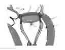 Fig. 01 - Cardiac valve prosthesis