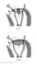 Fig. 02 - Cardiac valve prosthesis