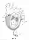 Fig. 03 - Cardiac treatment system and method