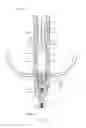 Fig. 03 - Hybrid compress bone fixator