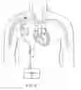 Fig. 06 - Graft anchor devices, systems and methods