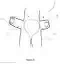 Fig. 07 - Wearable absorbent hygiene article comprising a magnetic switch