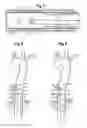 Fig. 04 - Introducer for lumen support or dilation