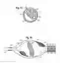 Fig. 07 - BALLOON AND MESH FOR LUMEN SUPPORT OR DILATION