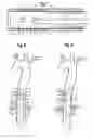 Fig. 04 - OFFSET BALLOONS FOR LUMEN SUPPORT OR DILATION